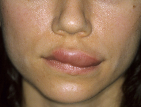 swelling fillers had inflammation patient lips